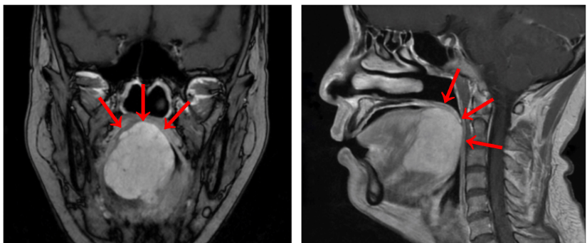 肿瘤|核酸检测时发现舌根大肿物，机器人经口手术摘瘤不“毁容”