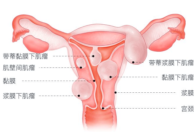 艾养身得了子宫肌瘤为什么要先治肝附艾灸穴位