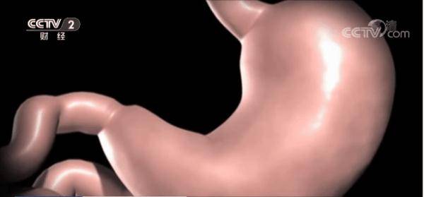 数量|为了瘦，女子跪求医生做缩胃手术