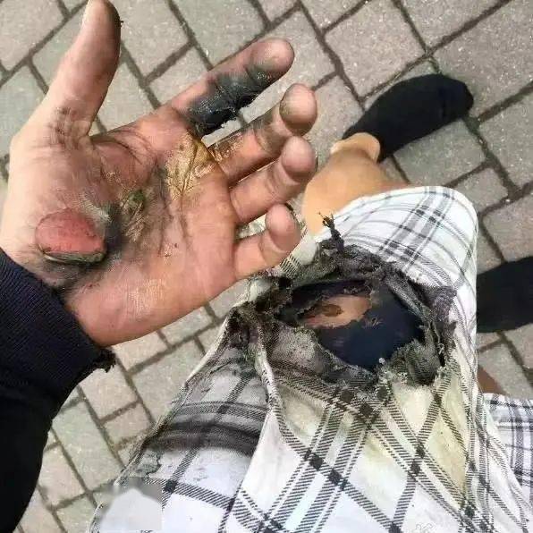 哥伦布的一名男子在一起电子烟爆炸中差点失去耳朵.3.