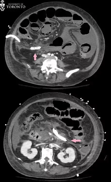 治疗|精选病例:典型的急性坏死性胰腺炎
