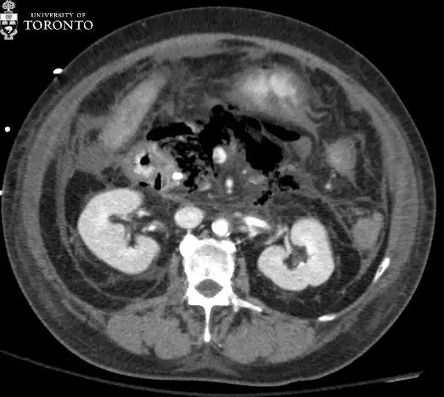 治疗|精选病例:典型的急性坏死性胰腺炎