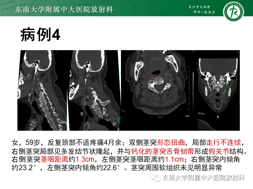 全面梳理:头颈部疾病——茎突综合征