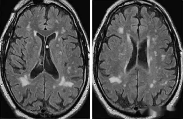 脑白质病变的影像学鉴别诊断