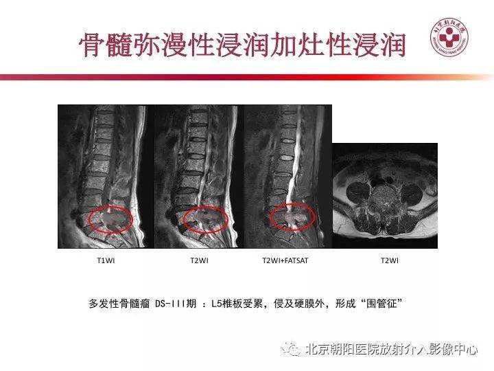 多发性骨髓瘤的影像诊断价值