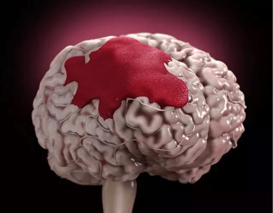 神经外科与3d打印技术3d打印导板导航下脑出血治疗的新篇章
