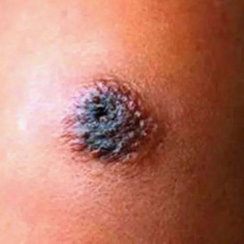 警惕关于皮肤炭疽这些知识要了解