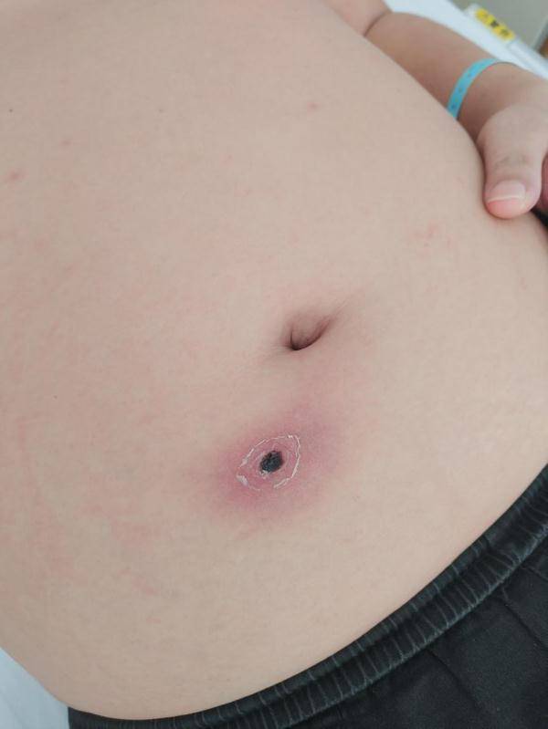 阿姨|可怕！厦门两市民高烧不退，核酸阴性！医生一查竟发现…