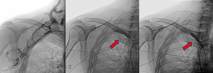 静脉|肾内科完成首例DSA下中心静脉狭窄球囊扩张术