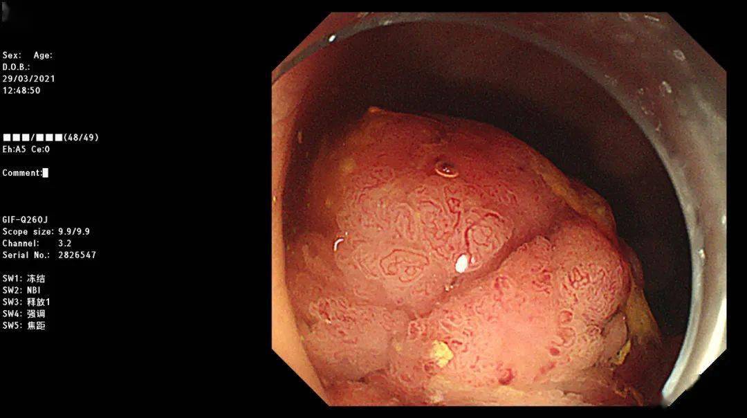 直肠管状腺瘤是什么图片