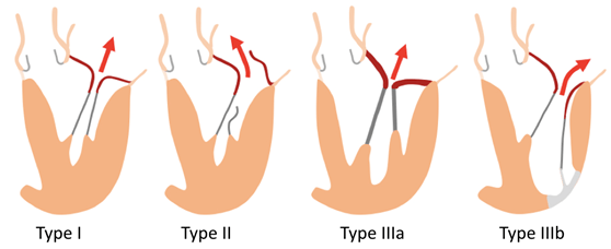 其对左心室(功能和重构),左心房和肺循环的影响,以及修复的可能性的