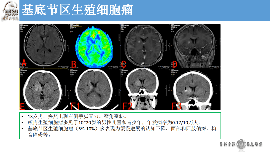 基底节区ct图谱图片