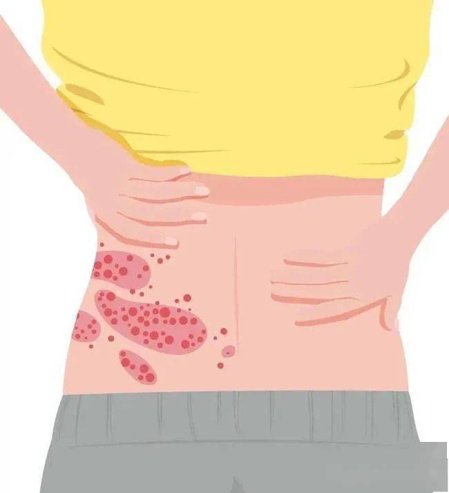 疱疹怎么引起的神经痛 d2bc1676be79489da68625777907afac.jpeg