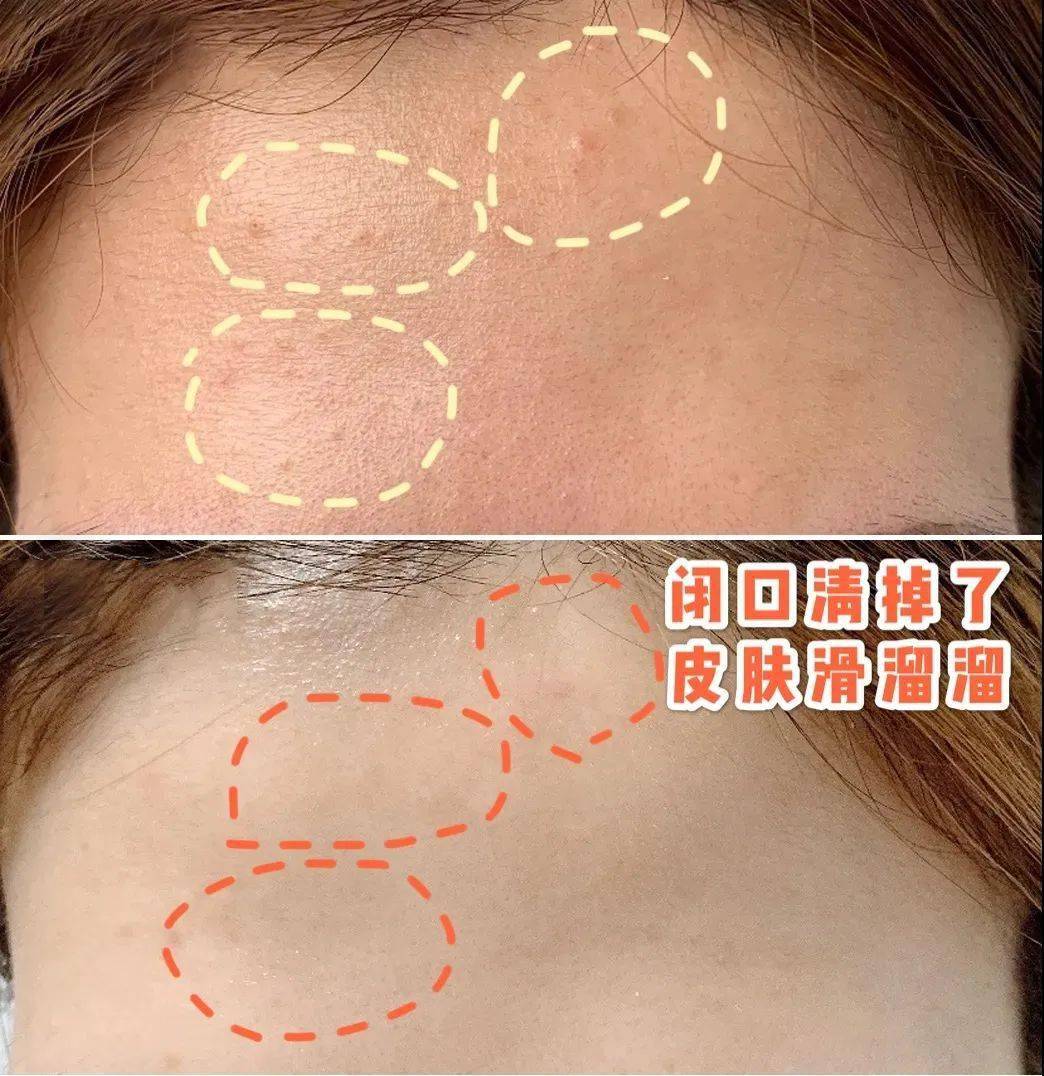 黑头|阿娇没骗我！2块钱敷一次酸，脸上“小疙瘩”竟被吞了！