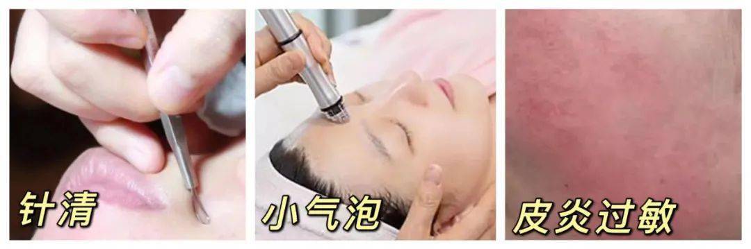 黑头|阿娇没骗我！2块钱敷一次酸，脸上“小疙瘩”竟被吞了！