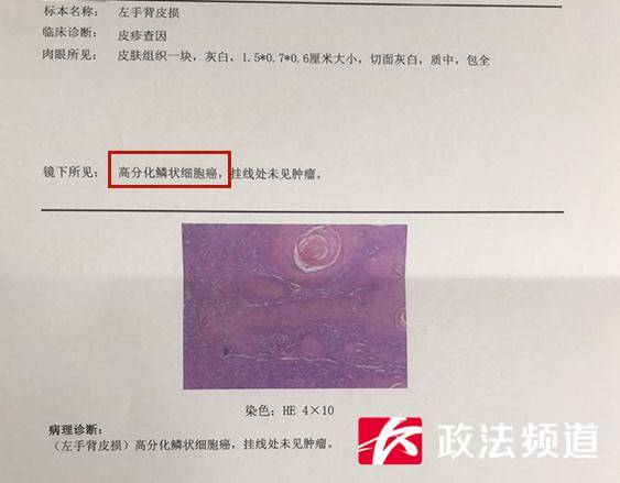 因膏药反复刺激,湖南70岁奶奶手上的小肿物竟恶化成癌_皮肤