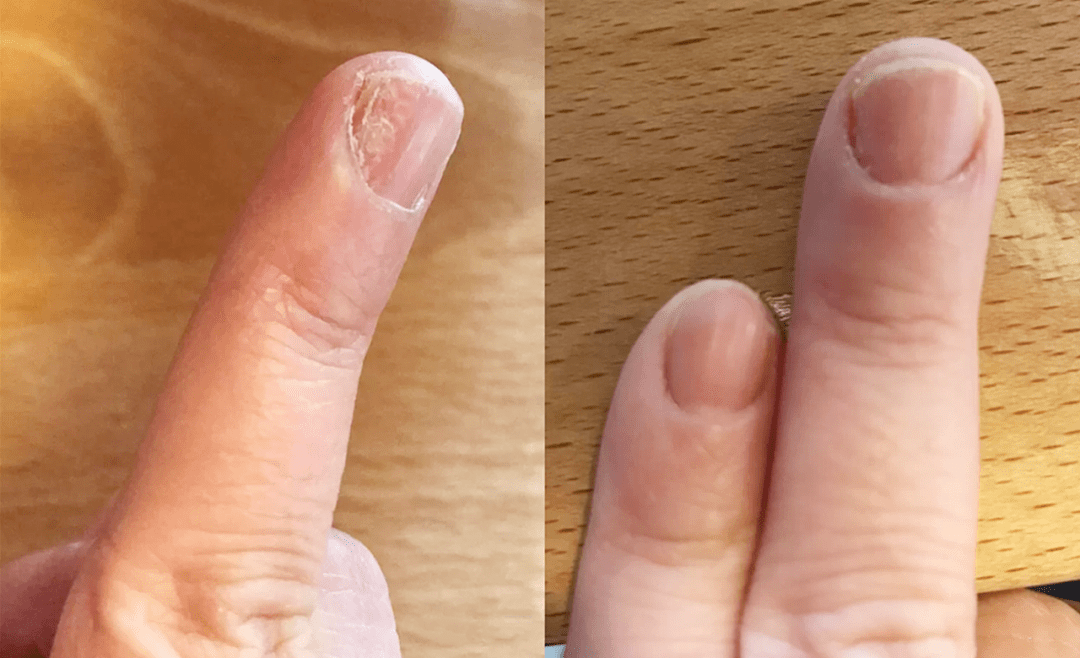 灰指甲怎么得的 ecf089353cd740c4872b094f201c9069.png