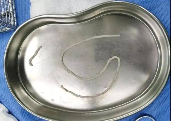 手术|头皮发麻！男子颈部长虫窝，手术竟取出35厘米长活虫