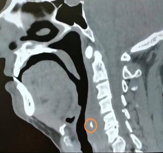 后壁|鱼刺卡喉用“老土方”？专家：不科学且危险！