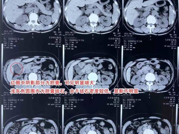 女子|女子结石发作疼痛难忍，就医检查发现结石已长到橄榄大小
