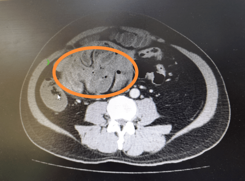 诊断|男子反复腹痛，竟是肚子里长了个巨大“蚕茧”