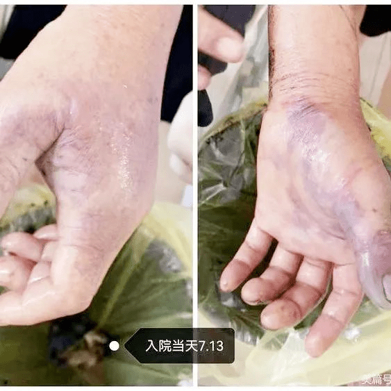 宁乡大爷被黄鸭叫刺伤,拇指截肢险丧命,处理鱼一定要小心!