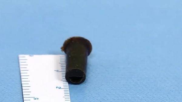 哨子|广东小伙被肺炎困扰20年，起因是6岁玩的一个玩具，家里有这个的注意了