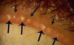 油脂|头晕、视物不清、流泪怕光，甚至失明，都是因这个很多人都有的眼病而起？