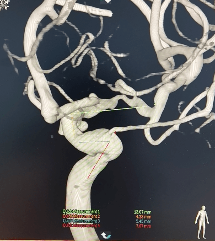 動脈瘤測量dsa 3d成像顯示為顱內串聯多發動脈瘤及左側大腦中動脈m1段