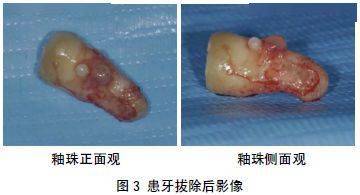 病例分享上頜第三磨牙釉珠引起急性牙周膿腫1例