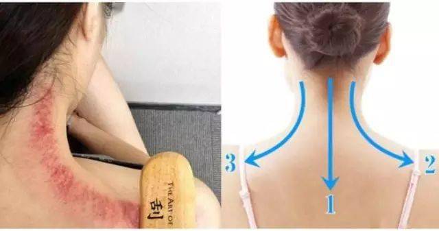 这些病刮痧可以缓解