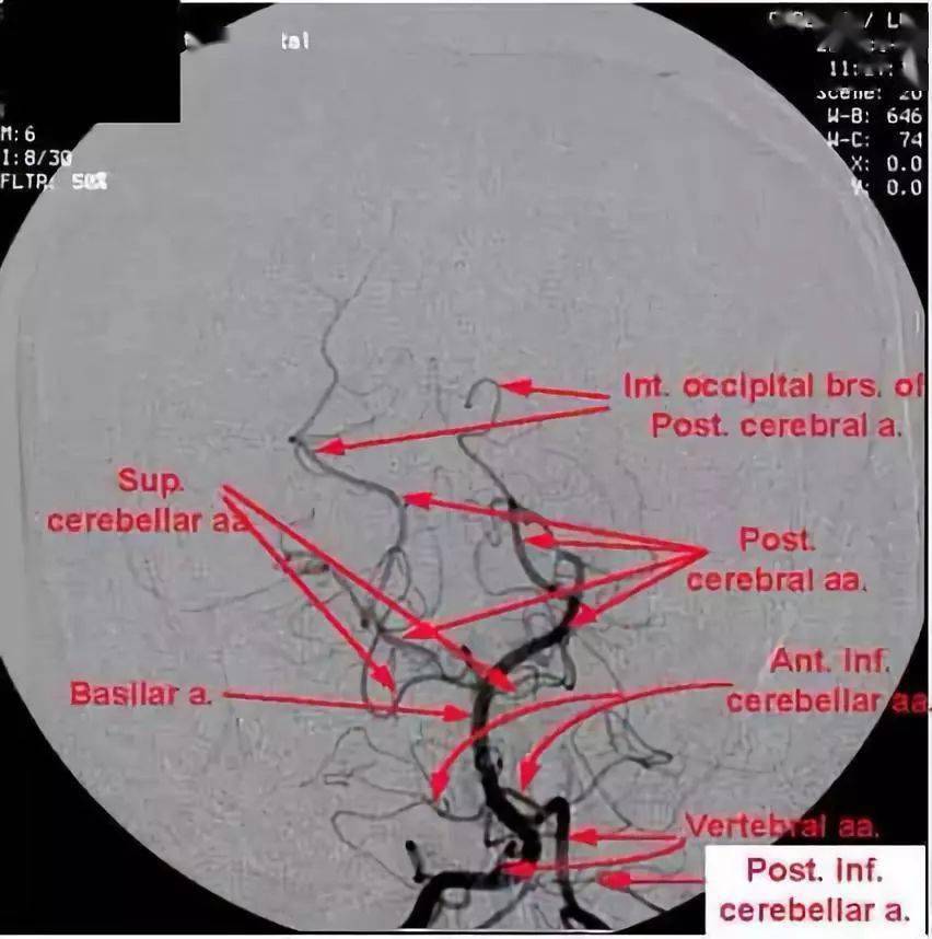 脑血管 dsa 阅片法则(1)动脉阅读法则(血流动力学法则:静中有动,动