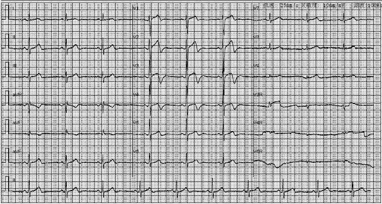 心肌缺血別隻會看st段改變這個心電圖變化高度提示冠脈狹窄