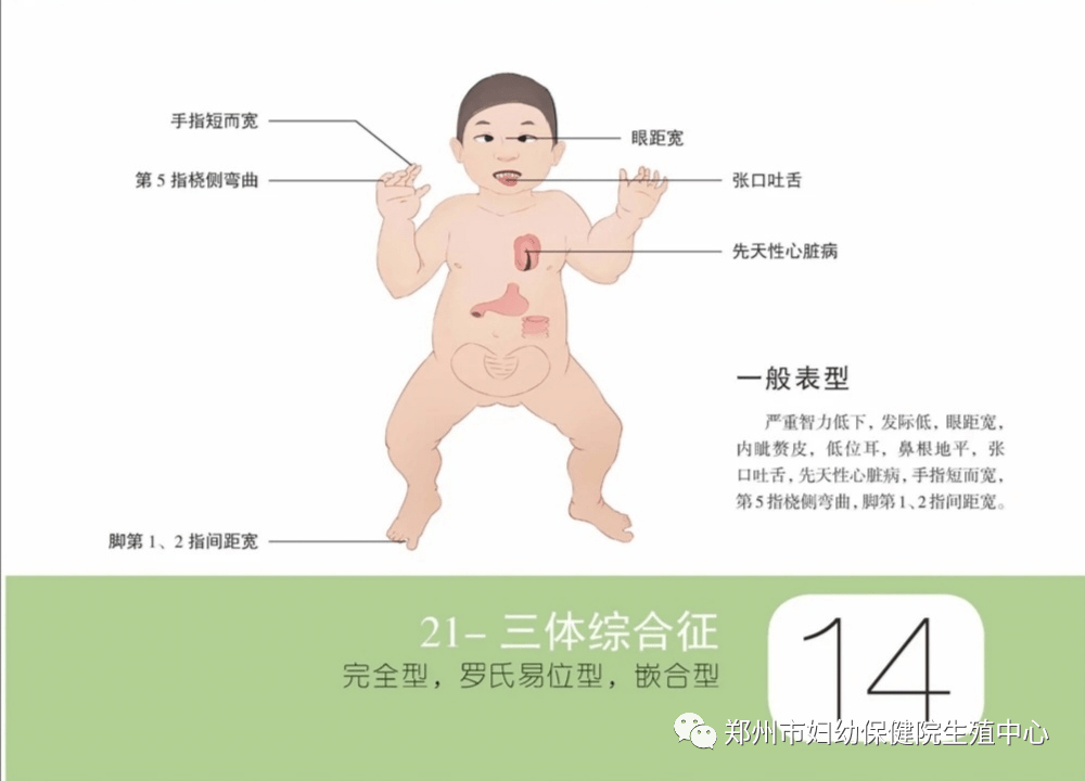 唐氏綜合徵又稱21三體綜合徵或先天愚型,患兒都有相似的面容,愛伸舌頭