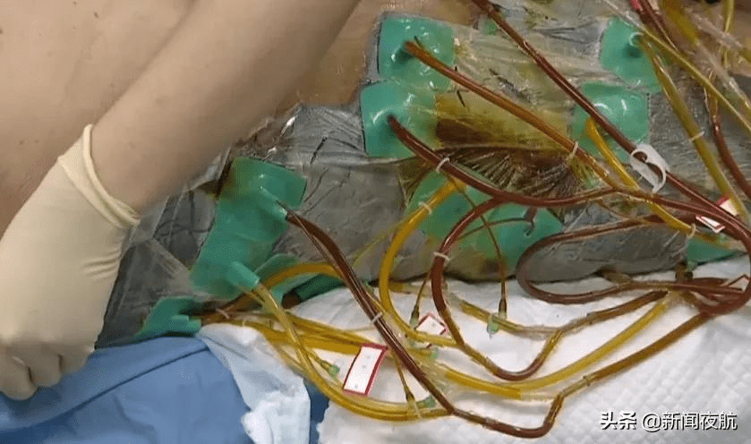 王国胜|只用三四天，皮肤从腋下烂到大腿，这是啥病啊？