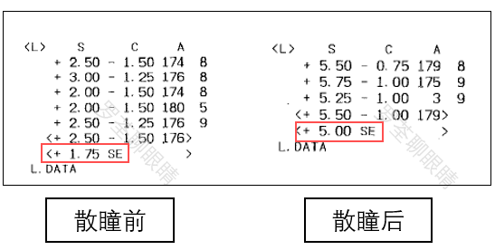 眼科醫生羅荃用不散瞳的驗光結果來猜遠視儲備不靠譜