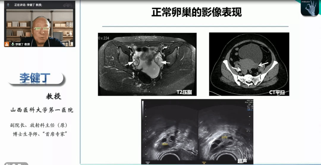 盆腔囊性灶图片