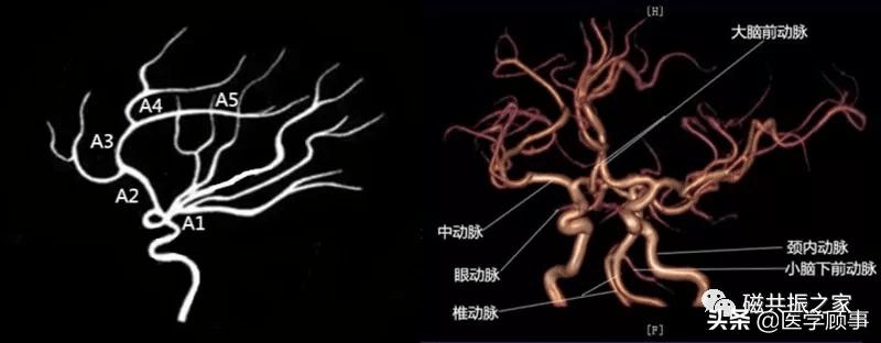 正常mra图像脑血管分段图片