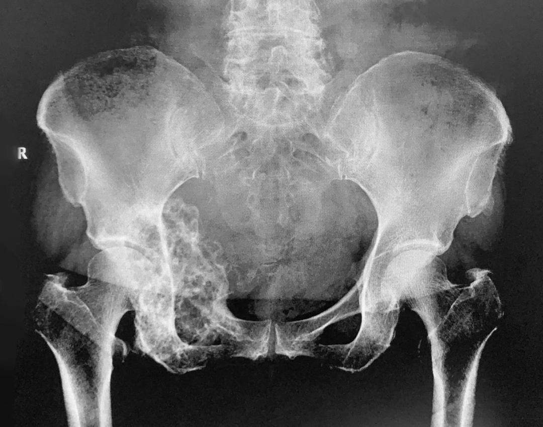 头条团队的力量市一院成功开展高难度半骨盆置换术