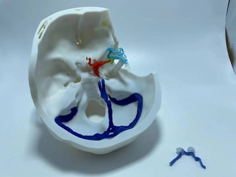 二医|高致死性脑动脉瘤破裂出血，3小时精准手术成功拆“炸弹”