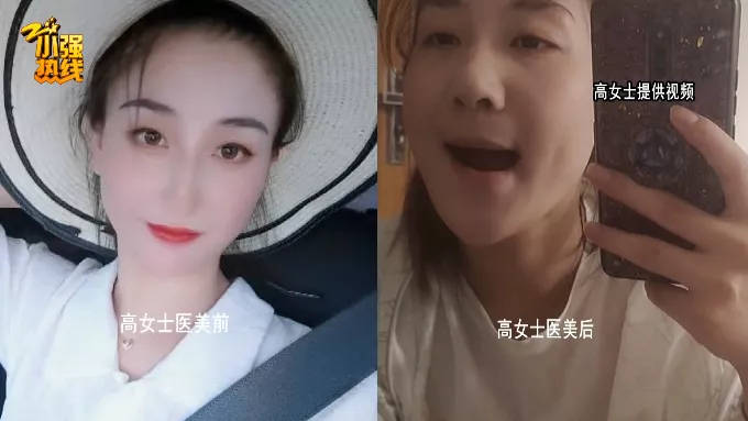 小区|杭州23岁女子做医美，脸上发生奇怪变化：上下嘴唇对不齐了