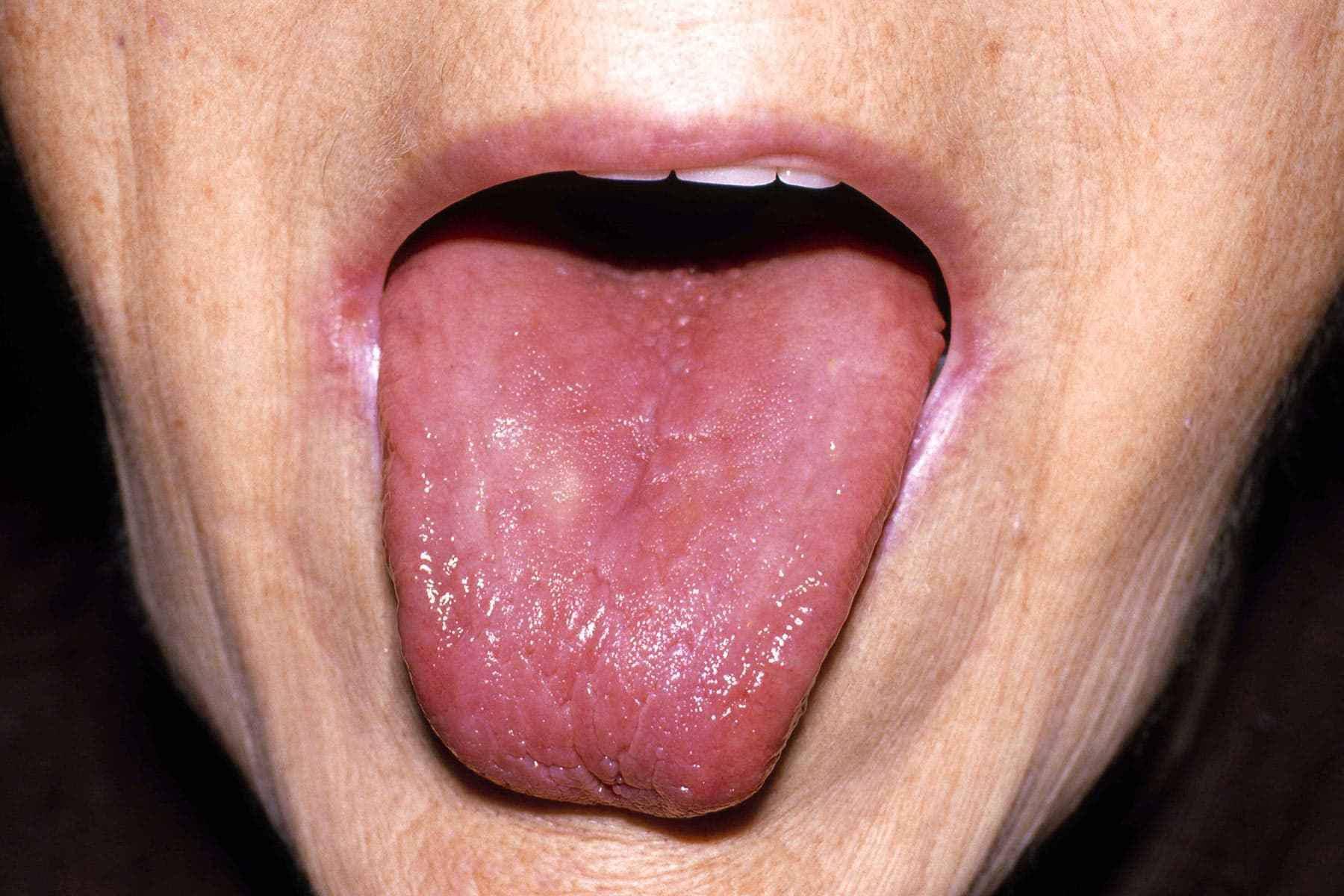 老人舌头烂了怎么办（长期烂舌头的原因）