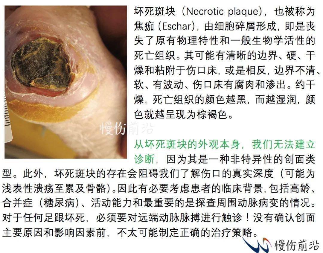 不要对足跟处干痂进行清创