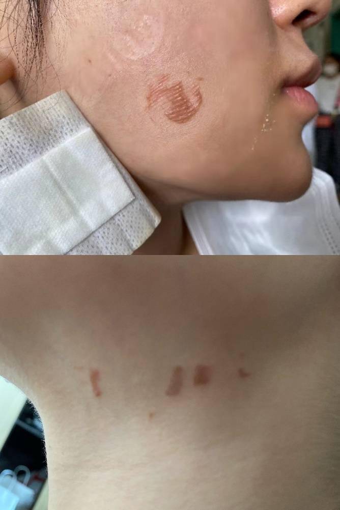 北京联合丽格美容医院热玛吉项目致用户面部烫伤(图2)