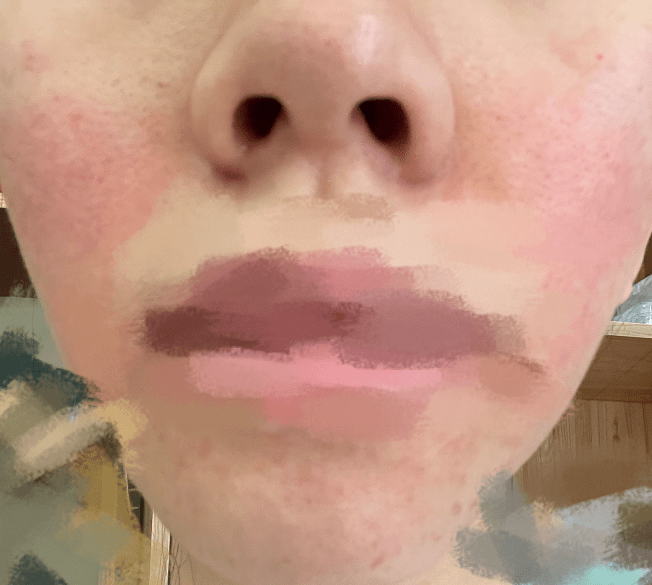 南宁小姐姐在医美机构做赠送项目时被灼伤律师出面后机构退款了