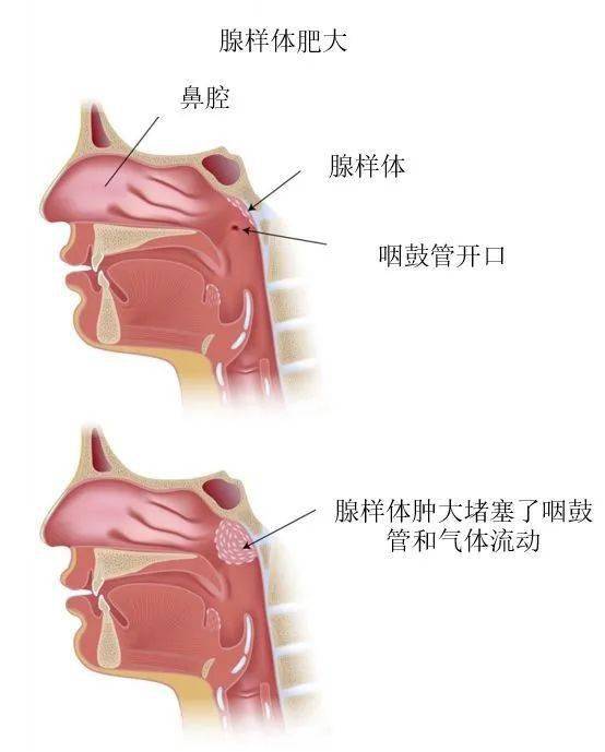 图片来源:作者提供扁桃体,是位于喉咙后面的两个腺体(如下图所示)