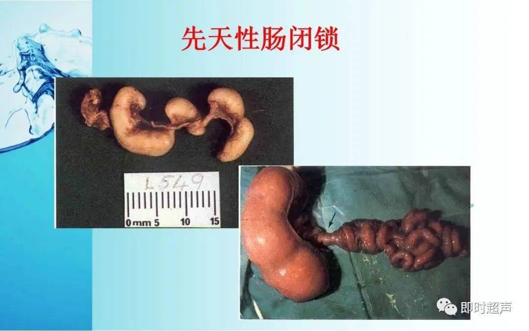 细节感人多图全面解读常见5类胎儿畸形超声诊断及处理