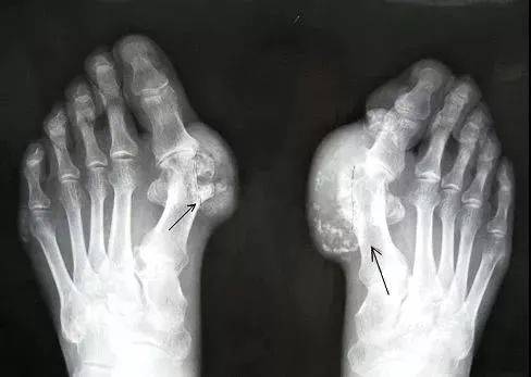 水果|痛风能吃的海鲜，糖尿病能吃的水果…大部分人都不知道！