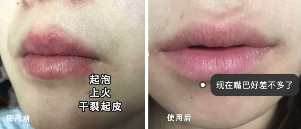 急救|唇纹又深又显老!急救起皮干裂,嘴巴像融化了一样,又软又糯贼滑溜!