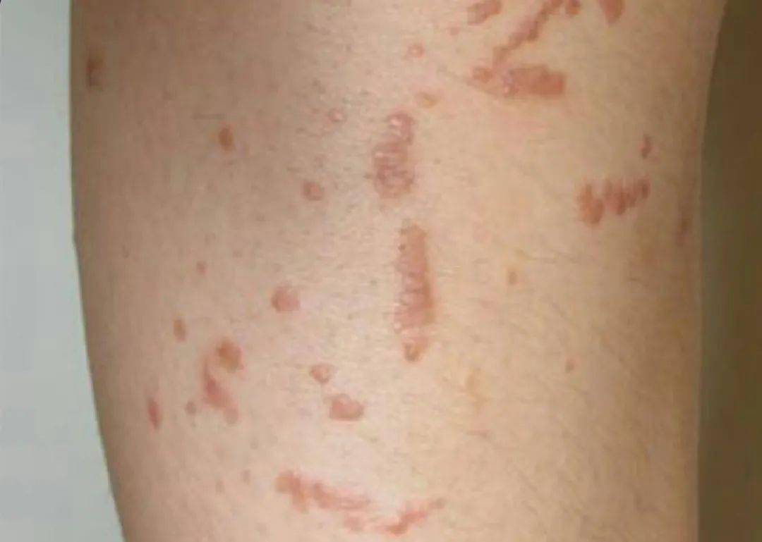 hpv感染,其实很普遍,皮肤有这种症状需要注意